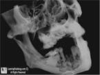 Bisphosphonate-related Osteonecrosis of the Jaw